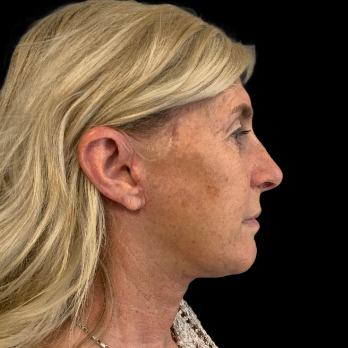 deepplane-facelift-after