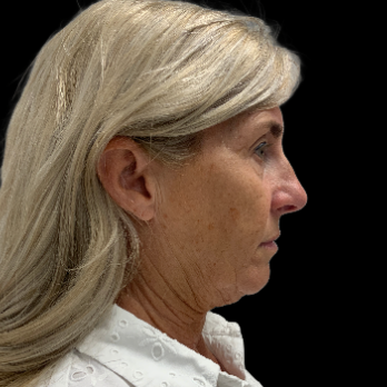 deepplane-facelift-before