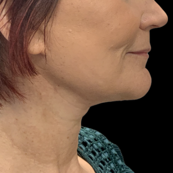 after-deep-plane-facelift-necklift
