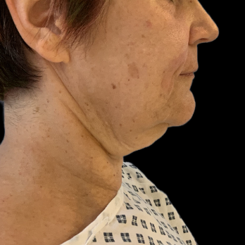 before-deep-plane-facelift-necklift