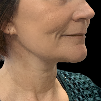 after-deep-plane-facelift-necklift