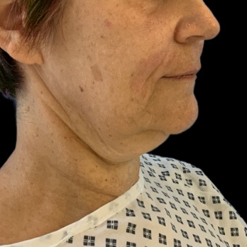 before-deep-plane-facelift-necklift