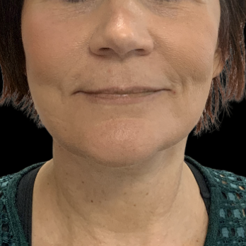 after-deep-plane-facelift-necklift