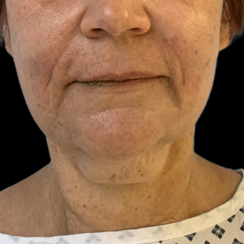 before-deep-plane-facelift-necklift
