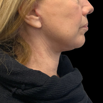 necklift-after