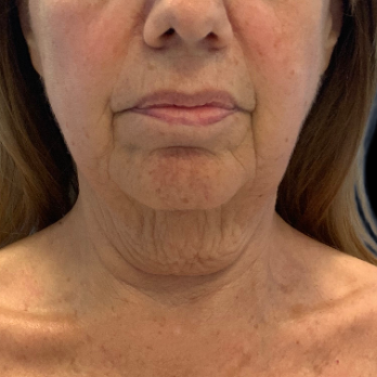 necklift-before