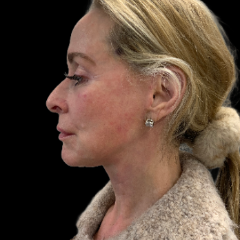 deepplane-facelift-after