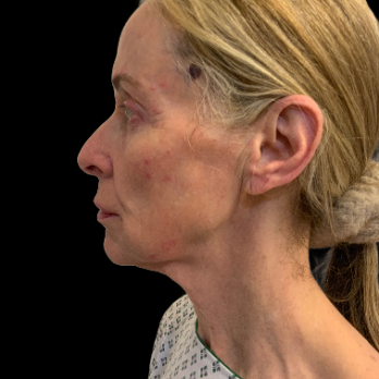 deepplane-facelift-before