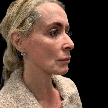 deepplane-facelift-after