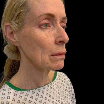 deepplane-facelift-before