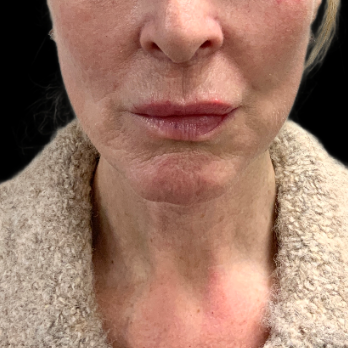 deepplane-facelift-after