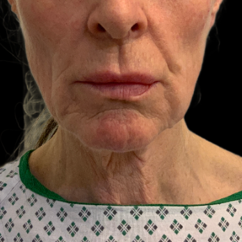 deepplane-facelift-before