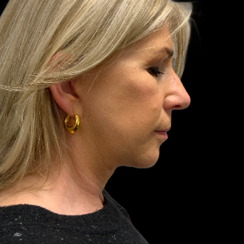 deepplane-facelift-after