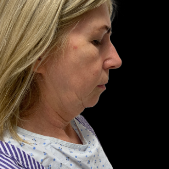 deepplane-facelift-before