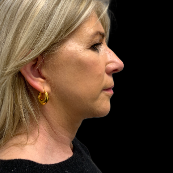 deepplane-facelift-after