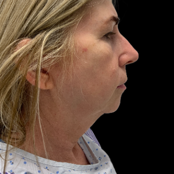 deepplane-facelift-before