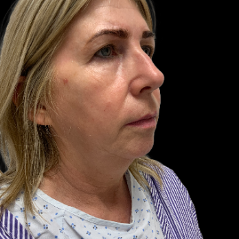 deepplane-facelift-before