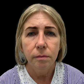 deepplane-facelift-before