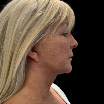 deepplane-facelift-sfter