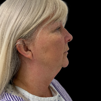 deepplane-facelift-before