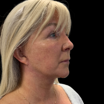 deepplane-facelift-sfter