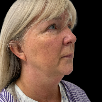 deepplane-facelift-before