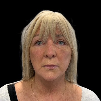 deepplane-facelift-after