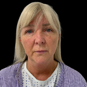 deepplane-facelift-before