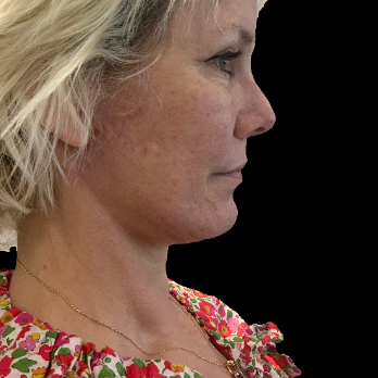 deepplane-facelift-after