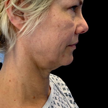 deepplane-facelift-before