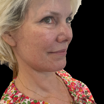 deepplane-facelift-after