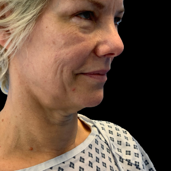 deepplane-facelift-before