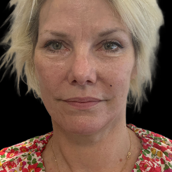 deepplane-facelift-after