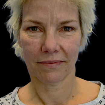 deepplane-facelift-before