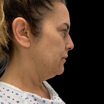 deepplane-facelift-before