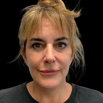 deepplane-facelift-after