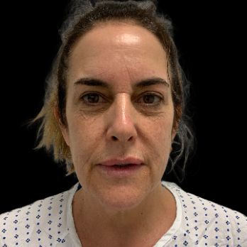 deepplane-facelift-before