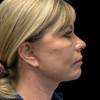 after-deep-plane-facelift-necklift-chin-implant