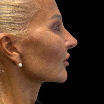 deepplane-facelift-after