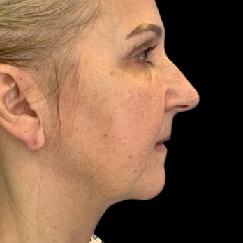 deepplane-facelift-before