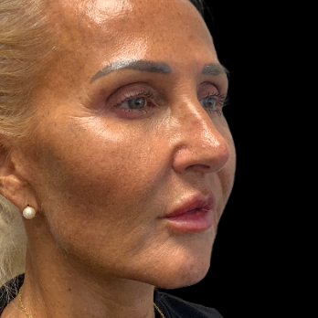 deepplane-facelift-after