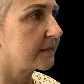 deepplane-facelift-before