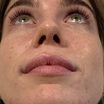 before-and-after-nostril-reduction