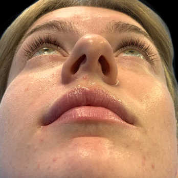 before-and-after-nostril-reduction