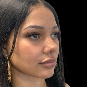 before-and-after-nostril-reduction