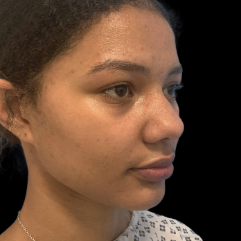 before-and-after-nostril-reduction