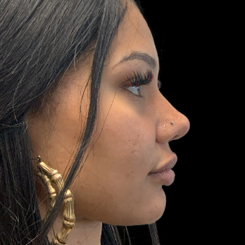 before-and-after-nostril-reduction