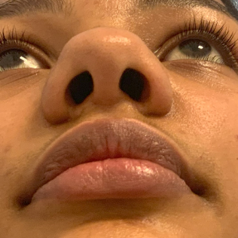 before-and-after-nostril-reduction