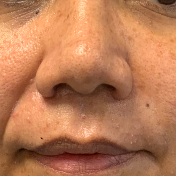 before-and-after-nostril-reduction