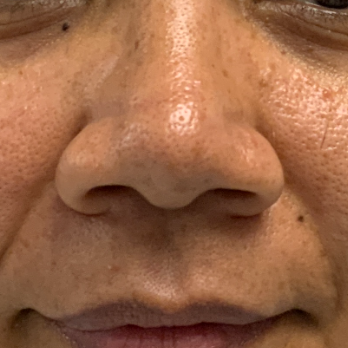 before-and-after-nostril-reduction